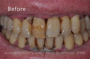 Patient with Stained Teeth and Dental Disease