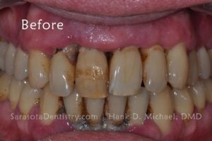discolored teeth with dental disease