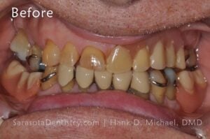 Before Picture of Patient with Periodontal Disease