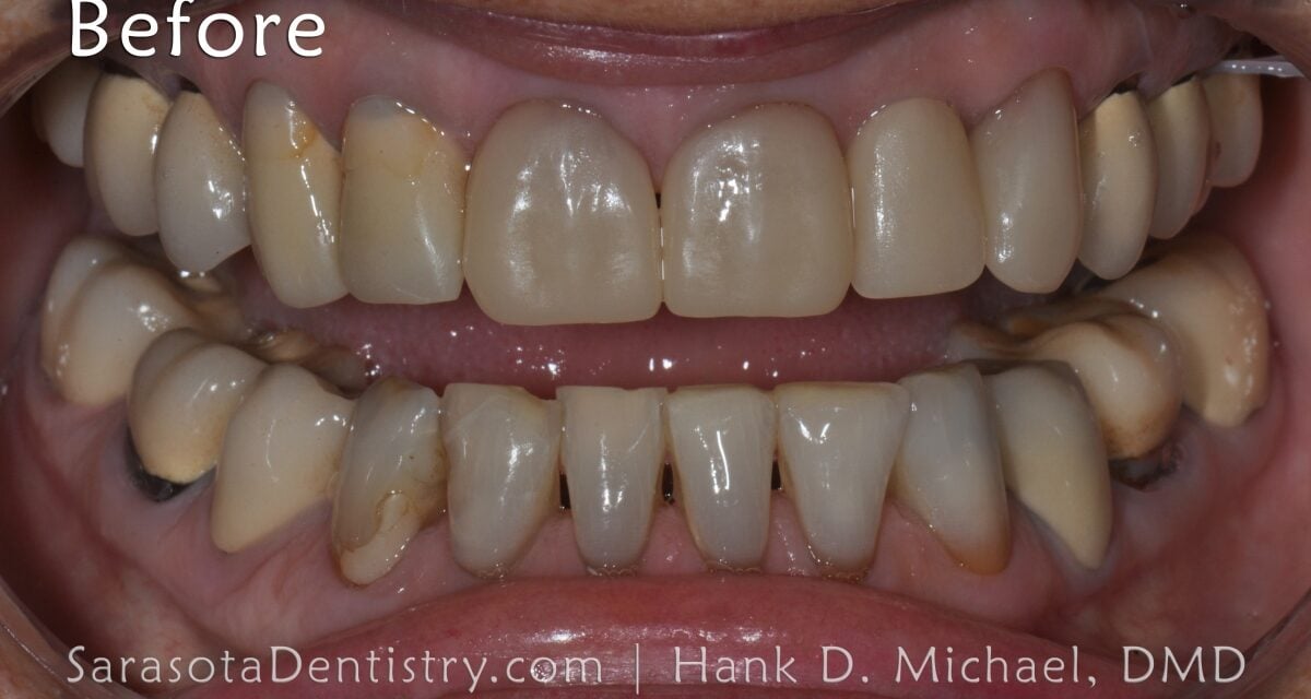 Black Triangle Teeth