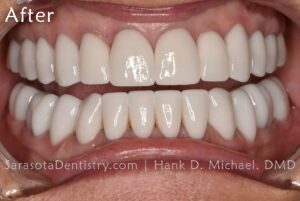 porcelain veneers