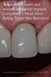immediate dental implant