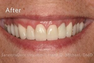 microthin veneers