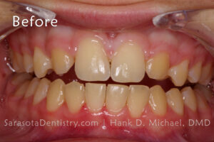 teeth discoloration