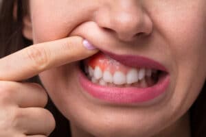 Close up of swollen and sore gums