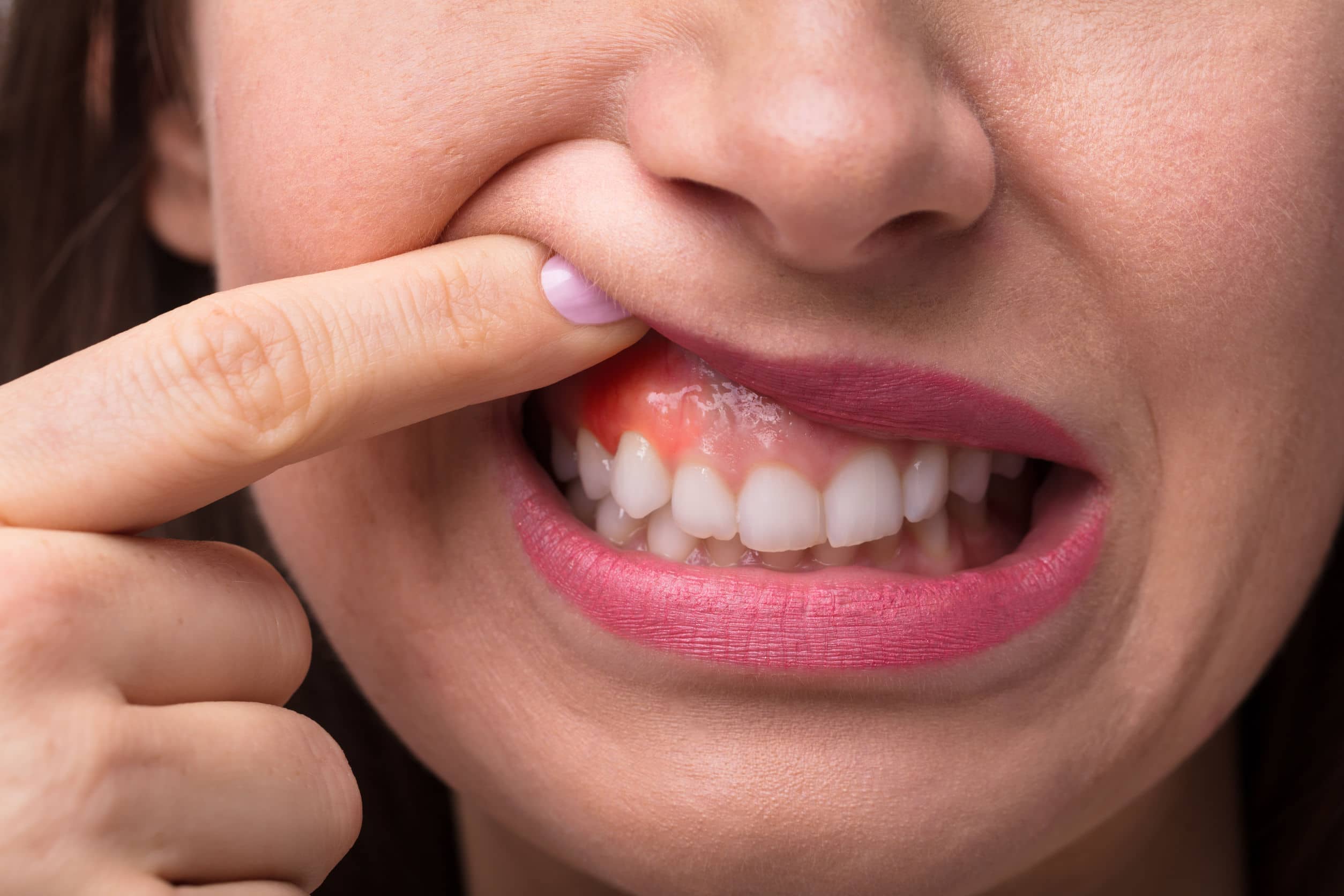 10 Easy Home Treatments For Swollen Gums | Fastmed Urgent Care