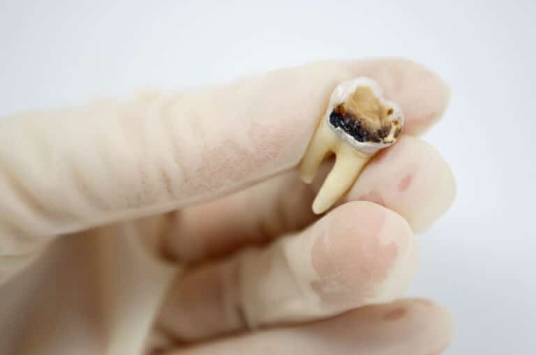 What is a dead tooth symptoms causes treatments
