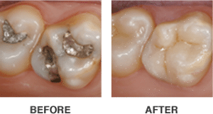 Before & After Same Day CEREC Crowns