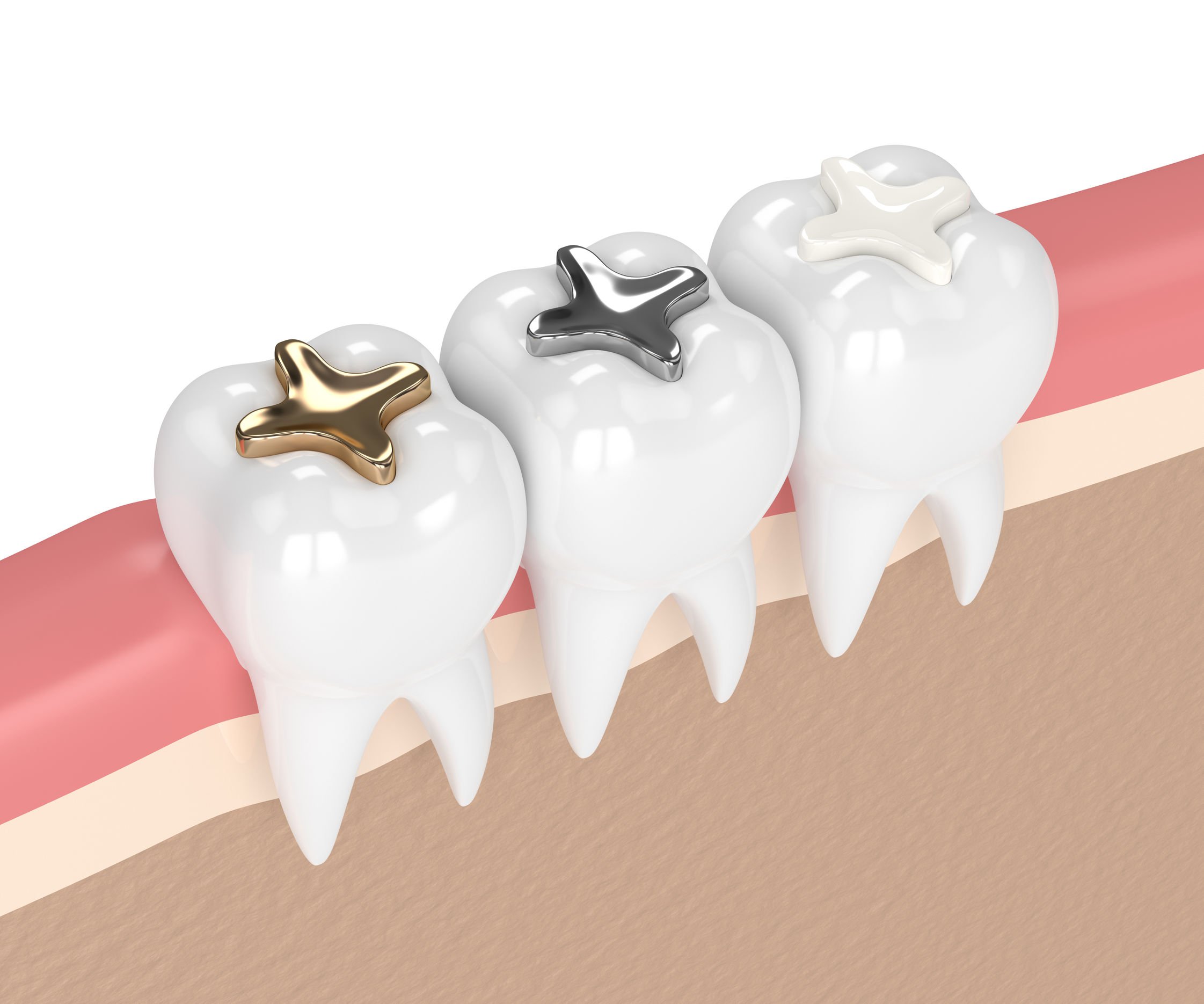Porcelain Fillings vs. Silver Fillings Sarasota Dentistry