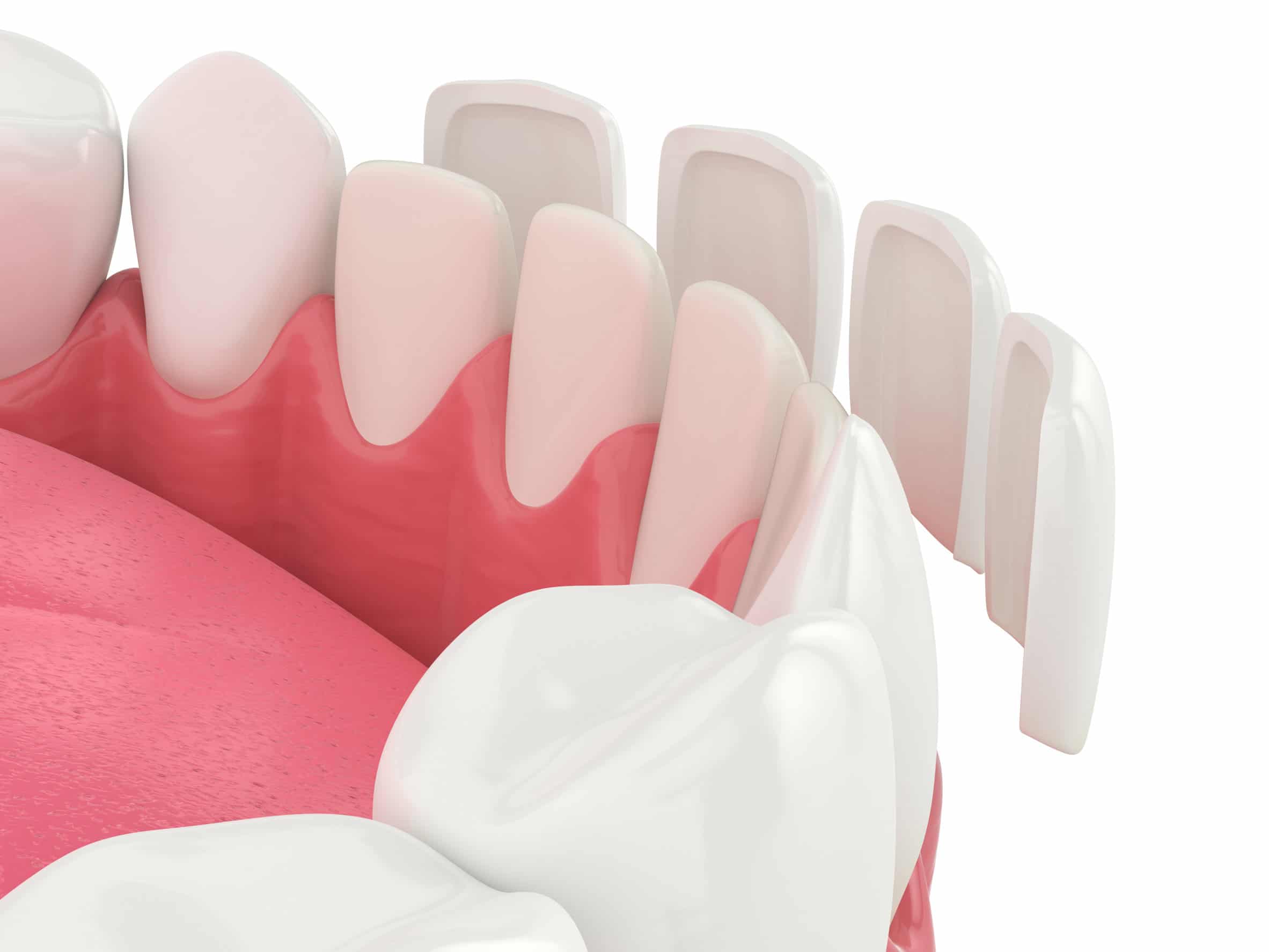 How Much Do Veneers Cost? Pros & Cons Sarasota Dentistry