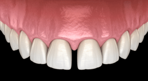 Diastema Causes and Treatments