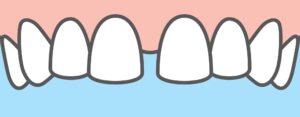 diastema gap in front teeth