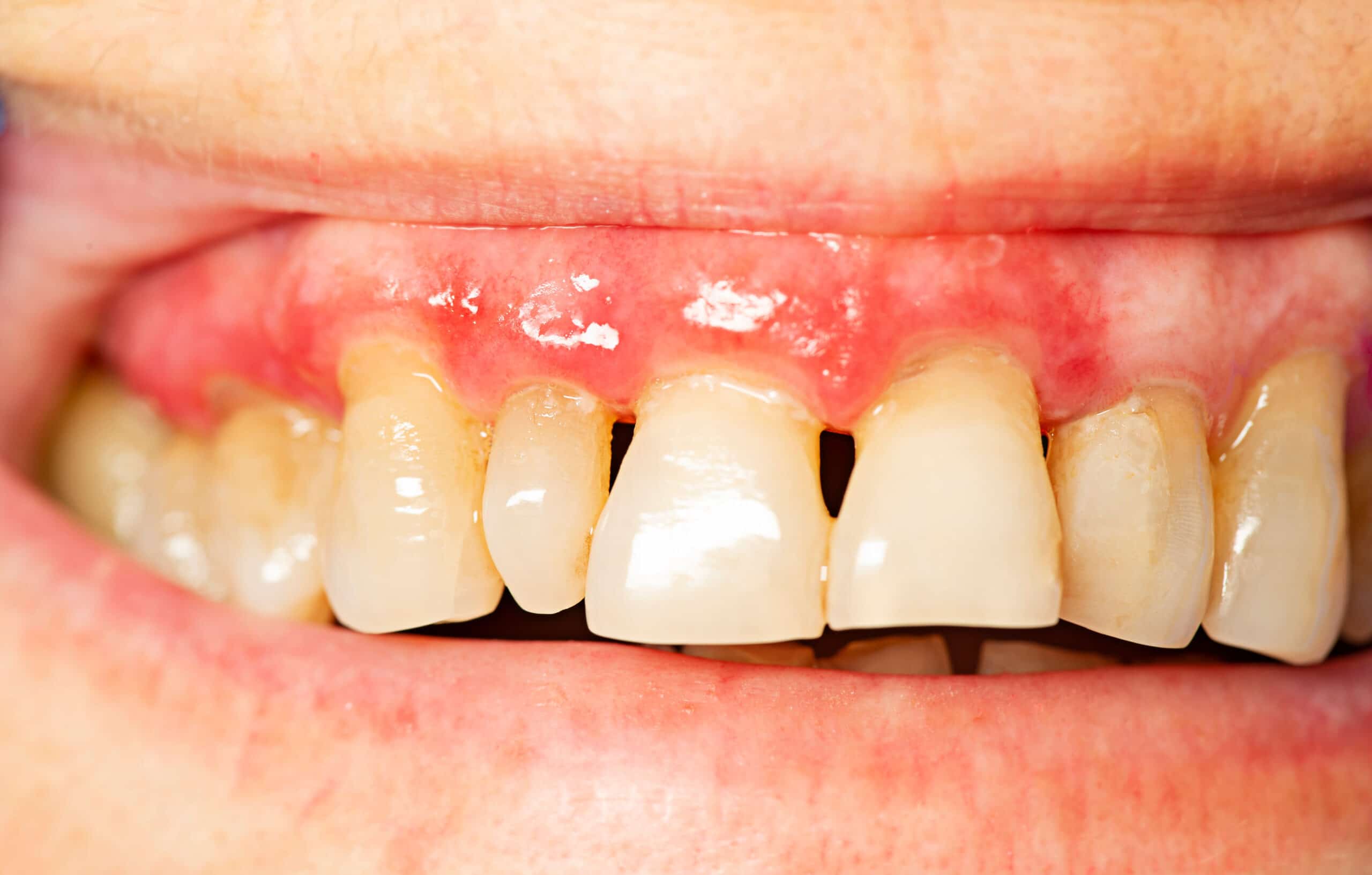 How Gum Disease Impacts Your Health