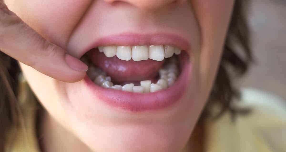 What Causes Crowded Teeth and How to Fix Them - Sarasota Dentistry