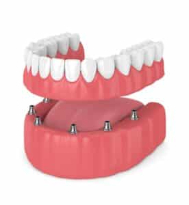 Implant Overdentures