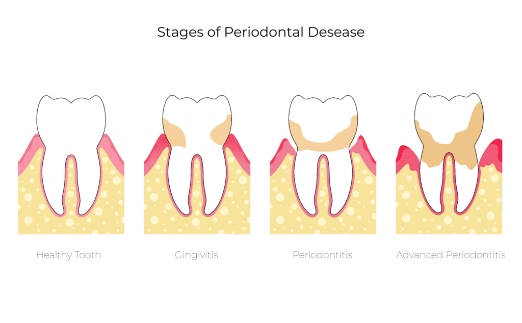 Stages of Periodontitis