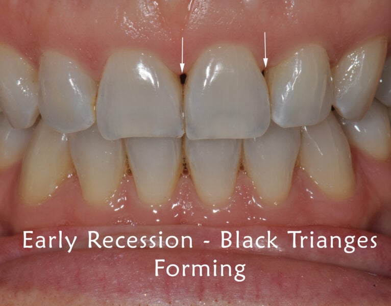 early gum recession - black triangle forming