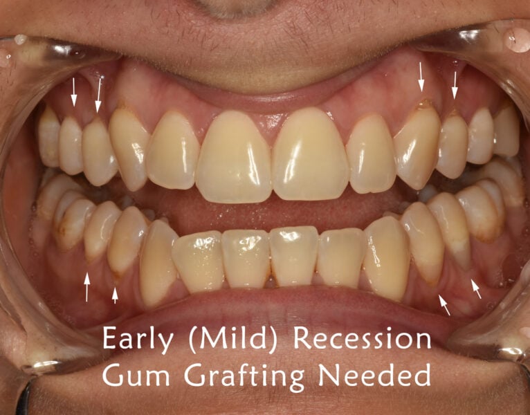 early mild gum recession - gum grafting needed