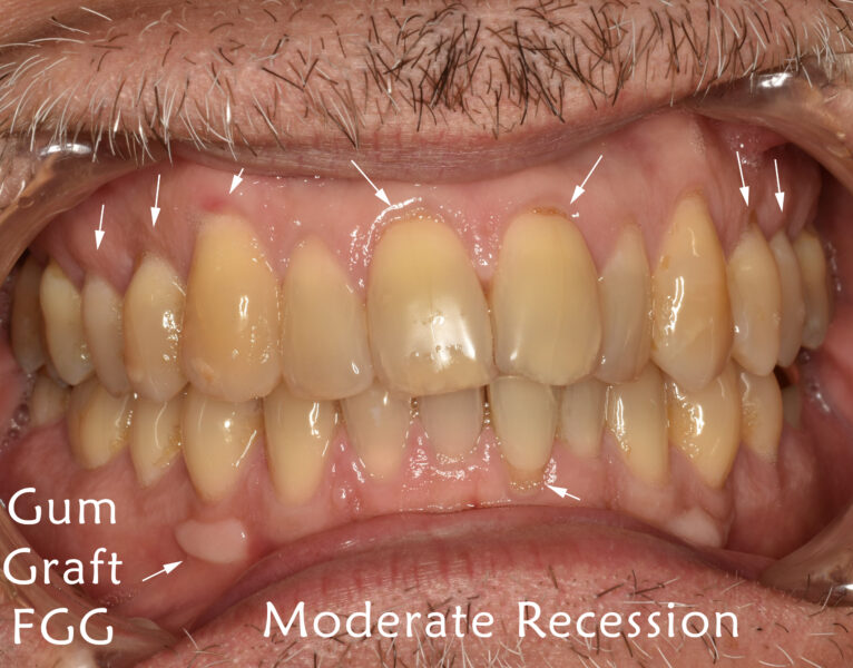 moderate gum recession with gum grafts