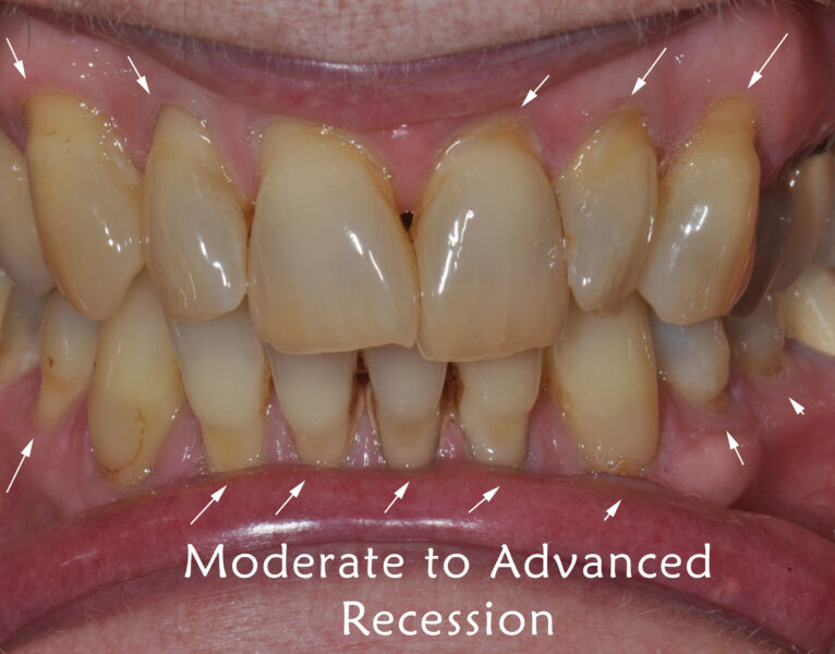 moderate to advanced gum recession