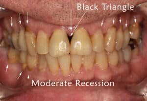 moderate gum recession with black triangles