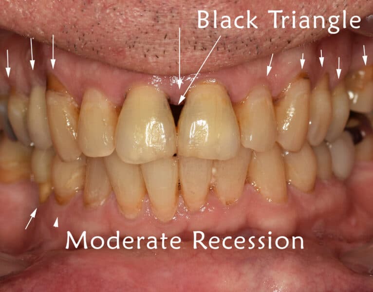 moderate gum recession with black triangle spacing between gums