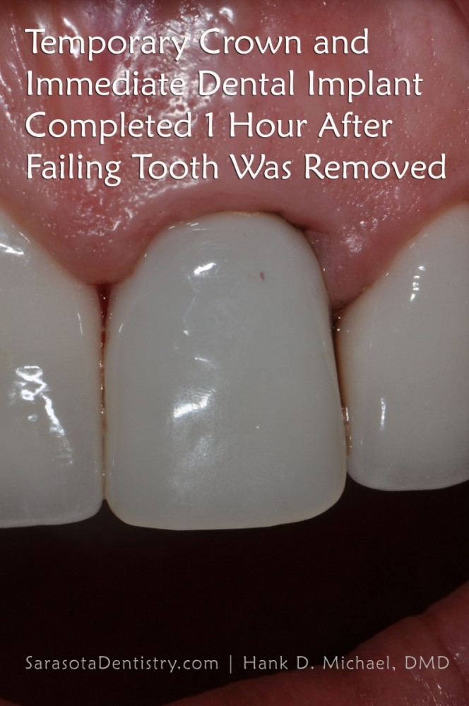 immediate dental implant case 10 - one hour rescue