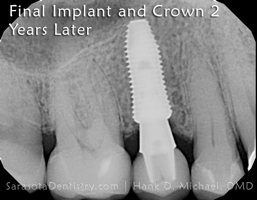 Dental Implant Case 7 immediate dental implant