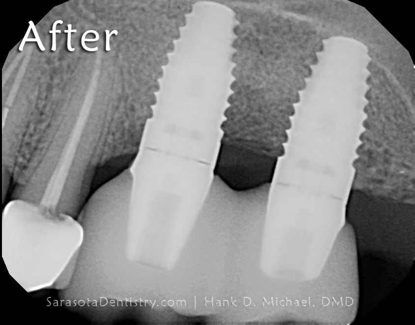 Sinus Augmentation Bone Graft #14