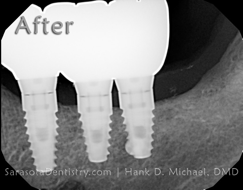 dental implant case 11-3